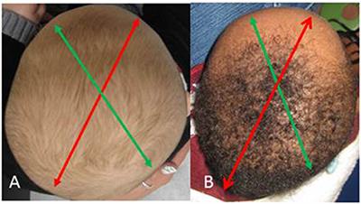 Correlative vs. Causative Relationship between Neonatal Cranial Head Shape Anomalies and Early Developmental Delays
